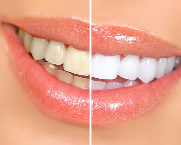 Smile before and after teeth whitening