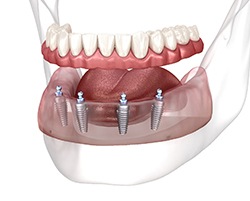 a graphic render of implant-supported dentures