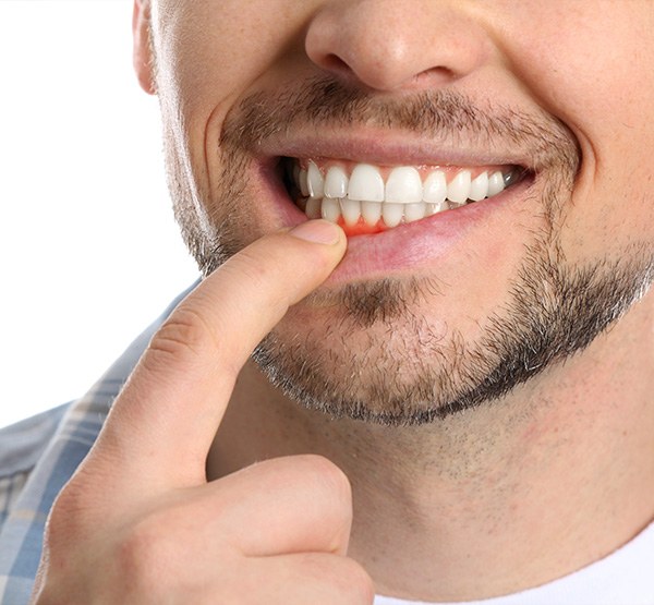 Smile with inflamed gums before gum disease treatment