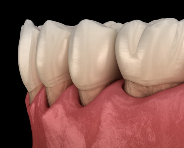 Animated smile in need of gum disease treatment