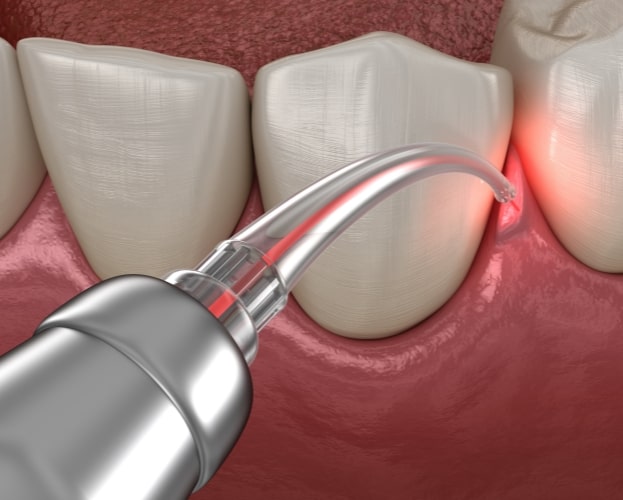 Animated smile during scaling and root planing treatment