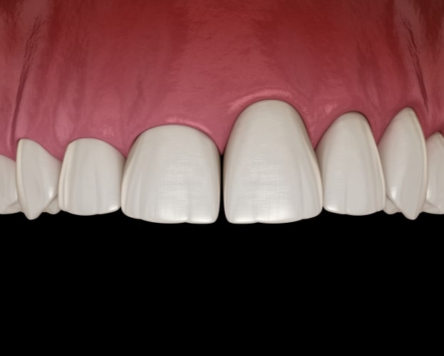 Animated smile with inflamed gums before antibiotic therapy for gum disease