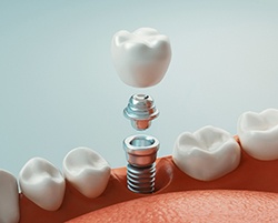 Illustration of single dental implant on bottom row of teeth