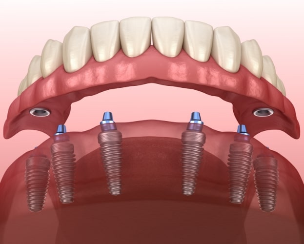 Animated smile during dental implant tooth replacement