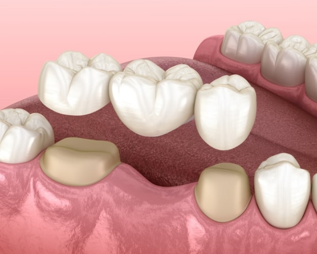 Animated smile during dental implant supported fixed bridge placement