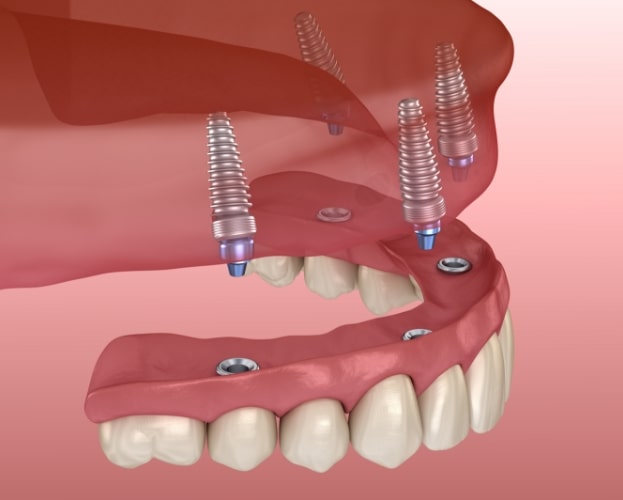 Animated smile during dental implant supported denture placement