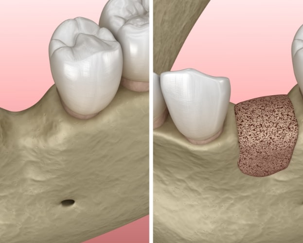 Animated smile with single missing tooth