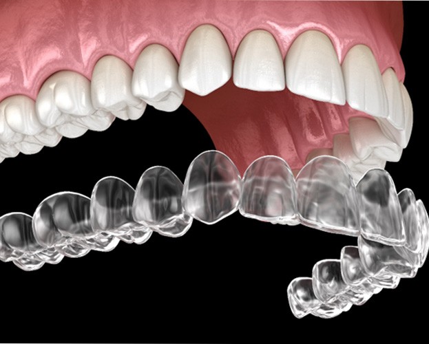 3D illustration of Invisalign and row of upper teeth 