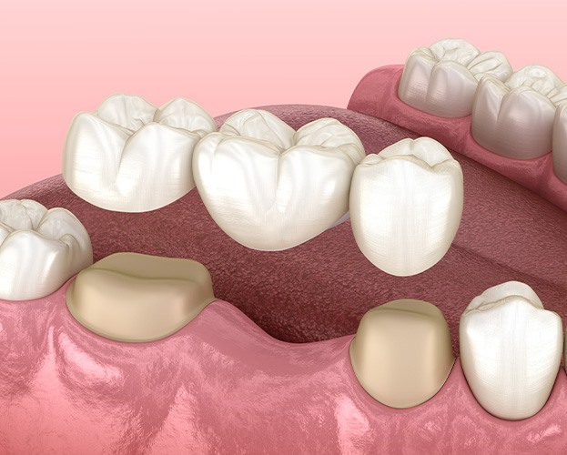 Animated smile during dental bridge placement