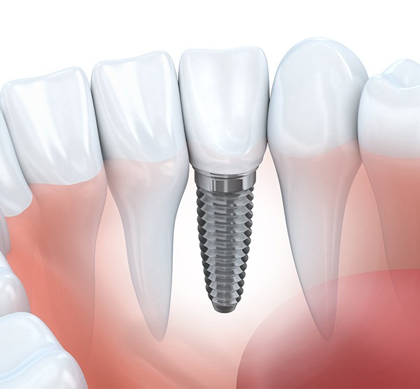 Animated smile after dental implant tooth replacement