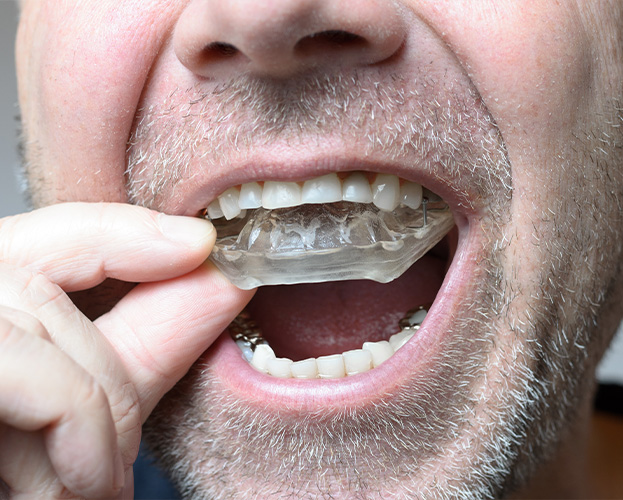 Dental patient placing custom nightguard for teeth grinding