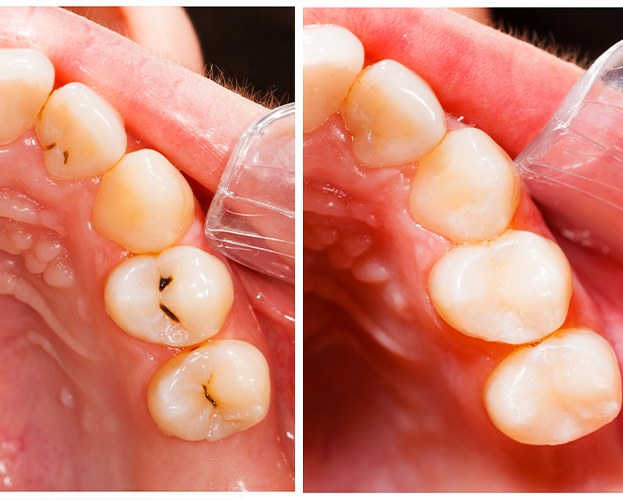 Smile before and after tooth colored filling placement