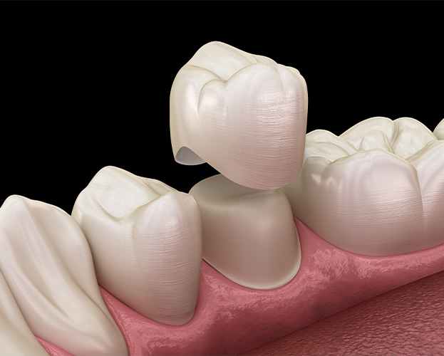 Animated smile during dental crown placement