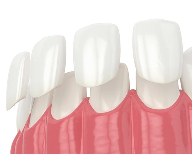 Illustration of veneers in Dudley